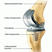 Knie Implantat Wien