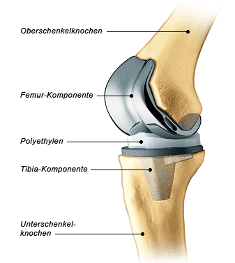 Knie Implantat Wien