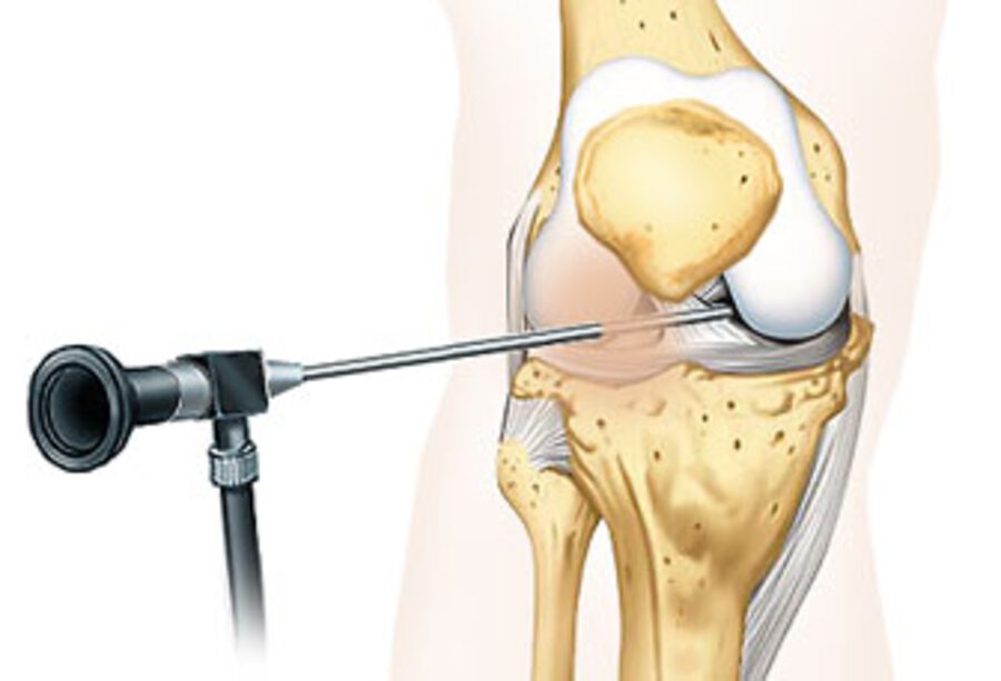 Операция по восстановлению коленного сустава. Операция артроскопия коленного сустава. Артроскопия коленного сустава резекция мениска. Артроскопическая резекция мениска коленного сустава. Артроскопия мениска коленного сустава операция.